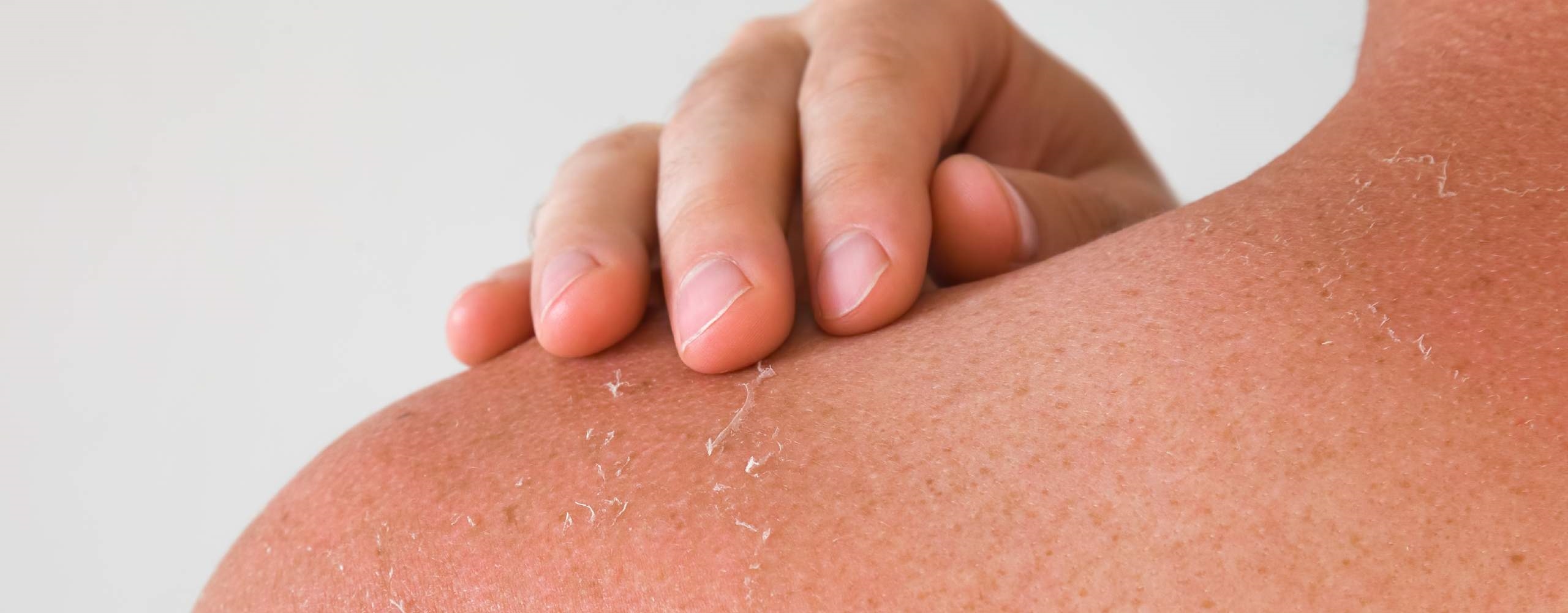 ผิวหนังแห้งเป็นขุย ผิวลอก ทำความเข้าใจสาเหตุและวิธีดูแลรักษาให้หายขาด