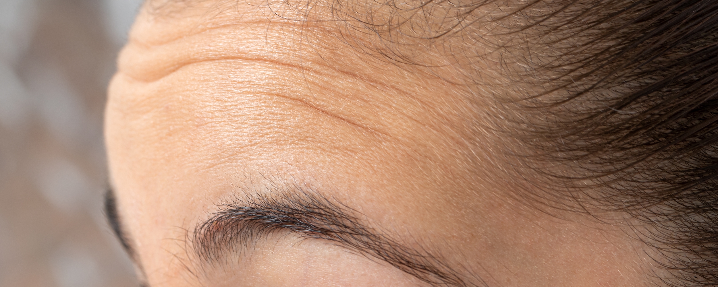 วิธีลดรอยหน้าผากย่น จัดการอย่างไรไม่ให้หน้าแก่ก่อนวัย