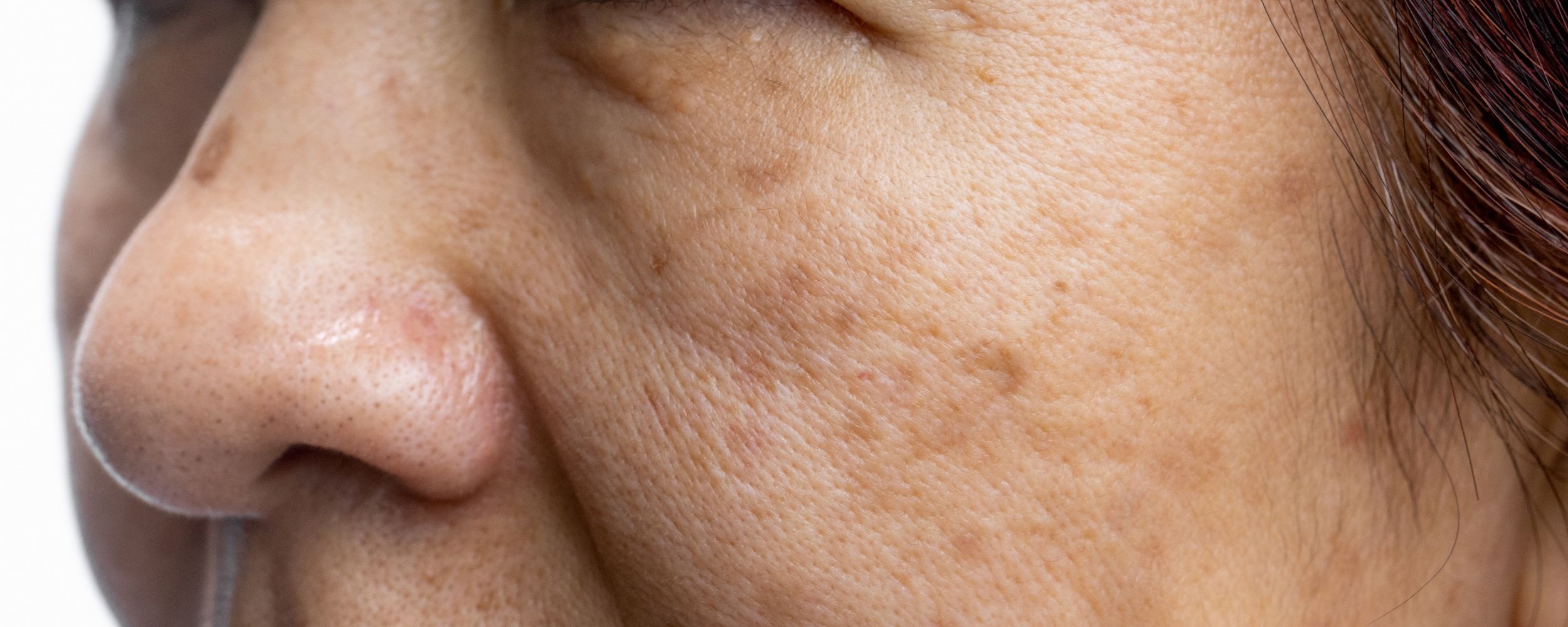 ฝ้าแดด คืออะไร สามารถรักษาได้หายได้ไหม