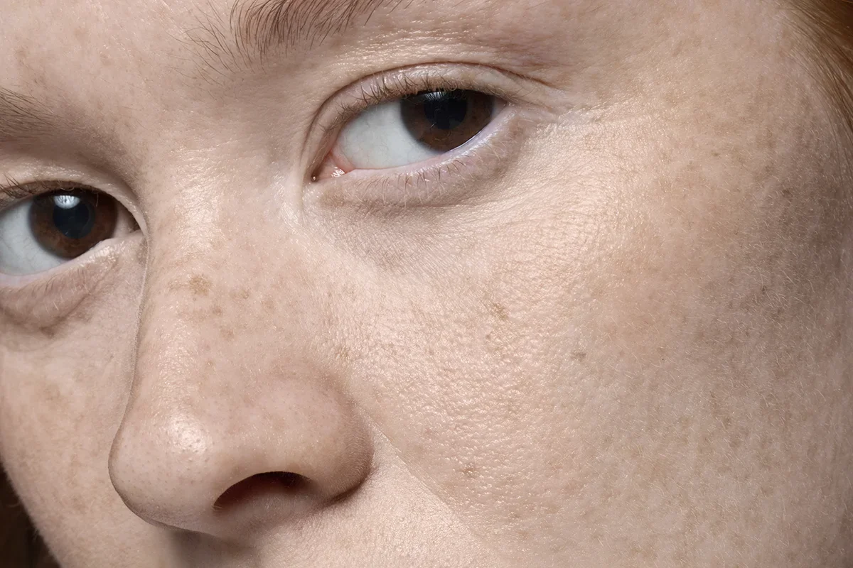 รู้จักสภาพผิวของตัวเอง เลือกตามปัญหาผิวที่กังวล