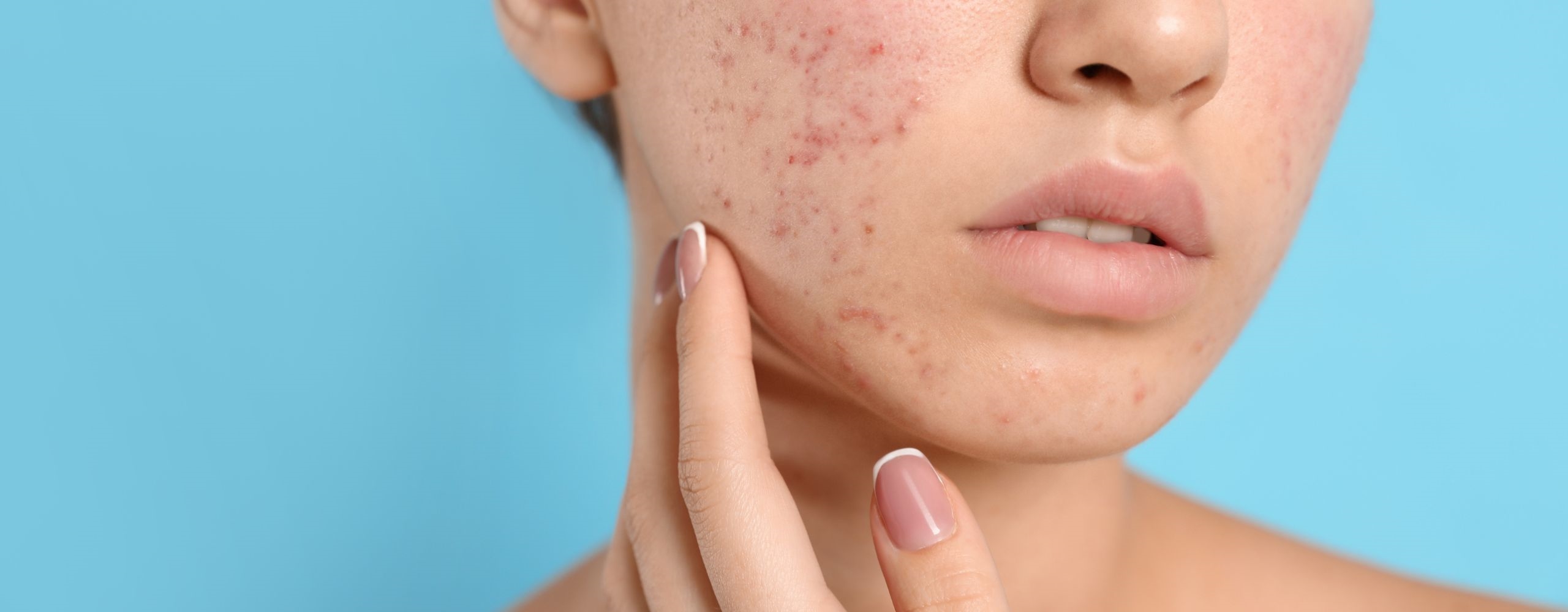 12 วิธีรักษารอยสิว ลดรอยดำรอยแดงจากสิวบนใบหน้า