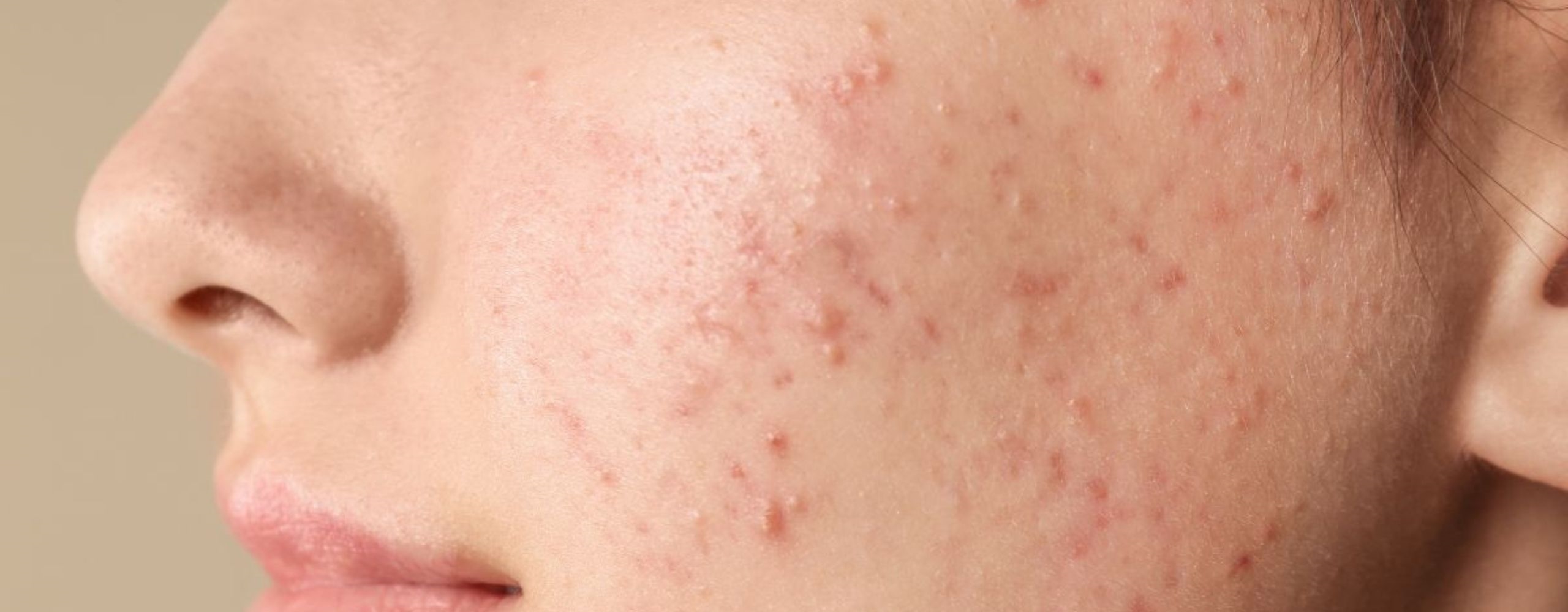 รู้จักสิว เข้าใจปัญหาผิว และวิธีป้องกันรักษาปัญหาสิว