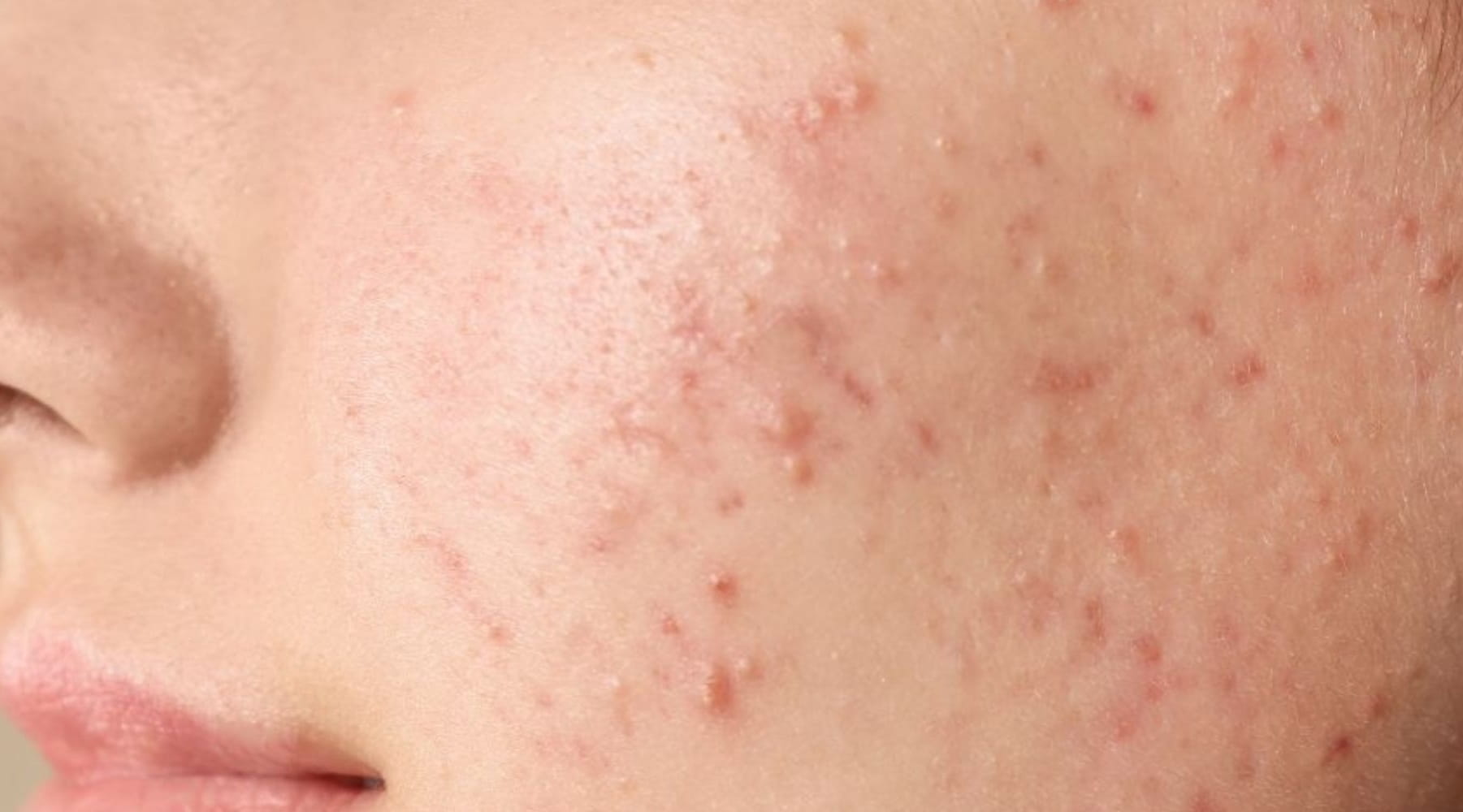 รู้จักสิว เข้าใจปัญหาผิว และวิธีป้องกันรักษาปัญหาสิว