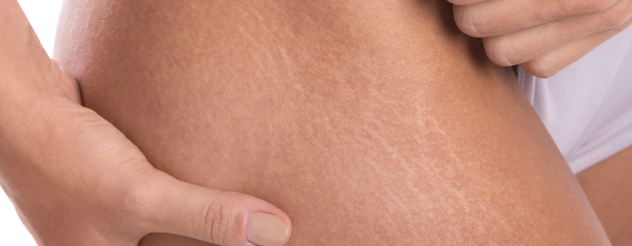 ขาแตกลาย แก้ยังไง? รวมวิธีแก้ผิวแห้งมาก คัน หรือ ขาแตกลาย ให้กลับมามีสุขภาพดี