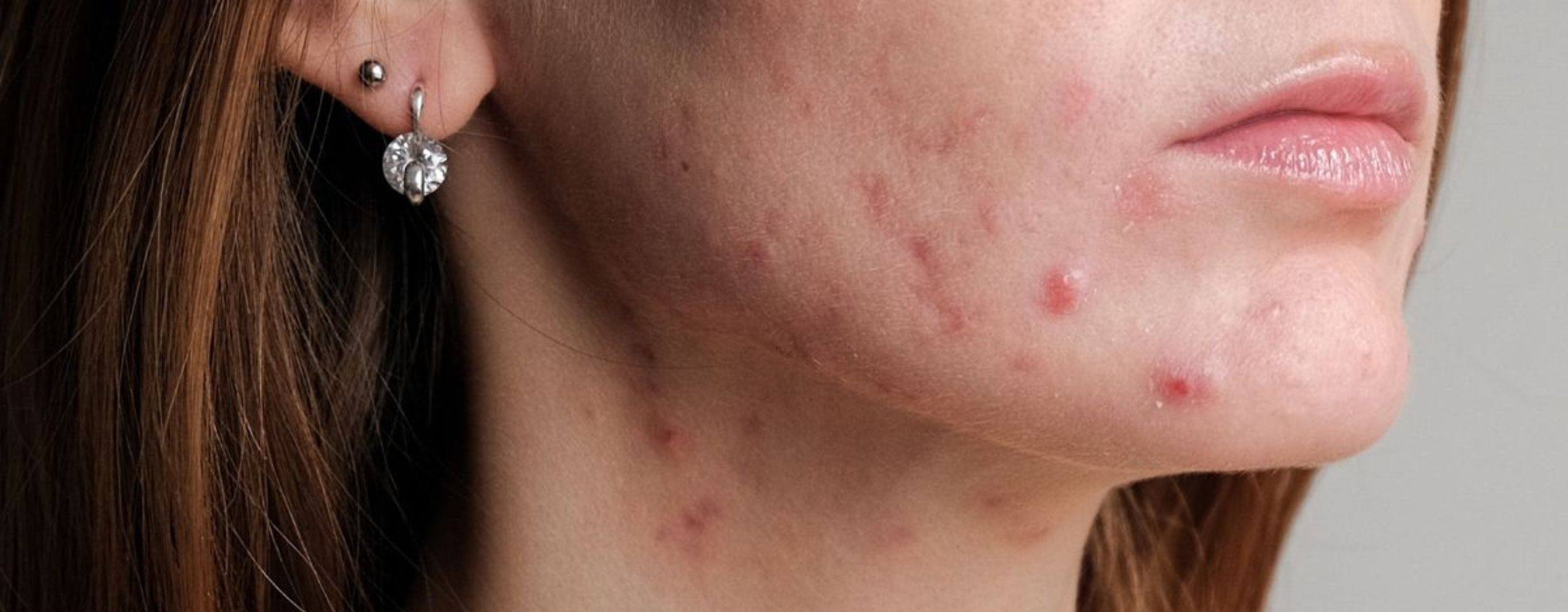 สิวหัวช้าง สาเหตุสิวที่ต้องรู้ และวิธีรักษาให้เห็นผลจริง