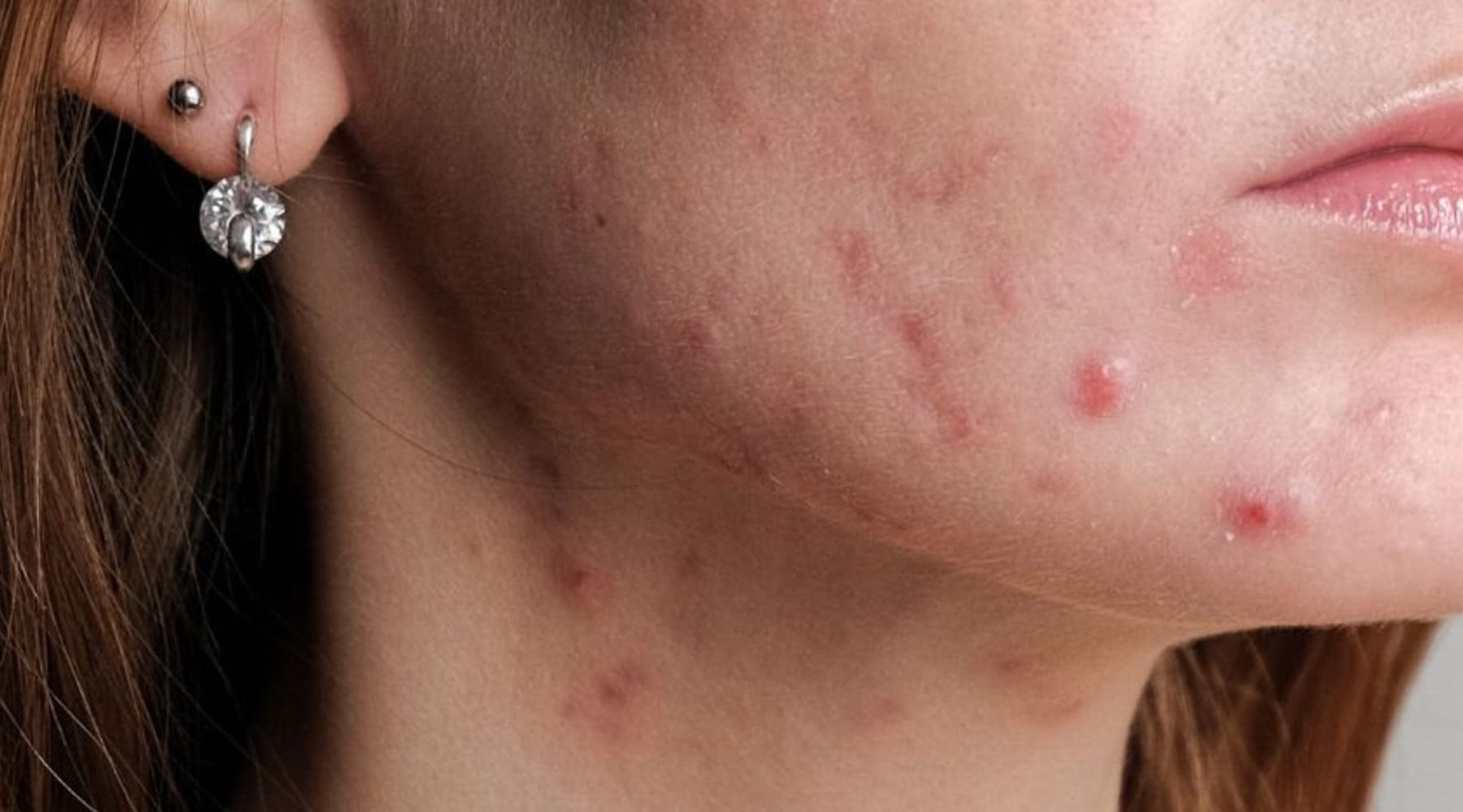 สิวหัวช้าง สาเหตุสิวที่ต้องรู้ และวิธีรักษาให้เห็นผลจริง