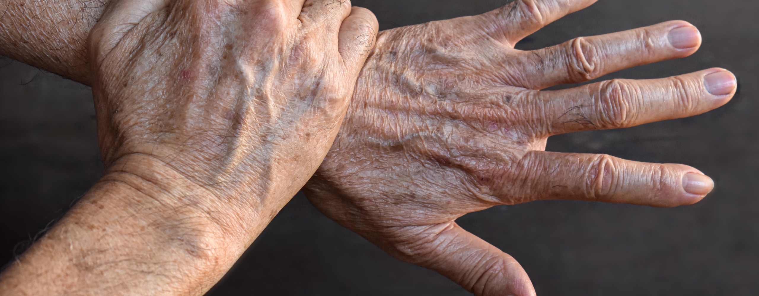 ผิวหนังเป็นจุดสีดำที่แขน เกิดจากอะไร? อันตรายไหม? พร้อมวิธีรักษาและป้องกัน