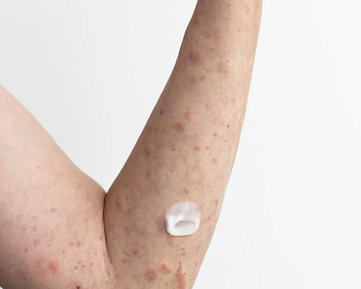 รอยดำหลังการอักเสบ