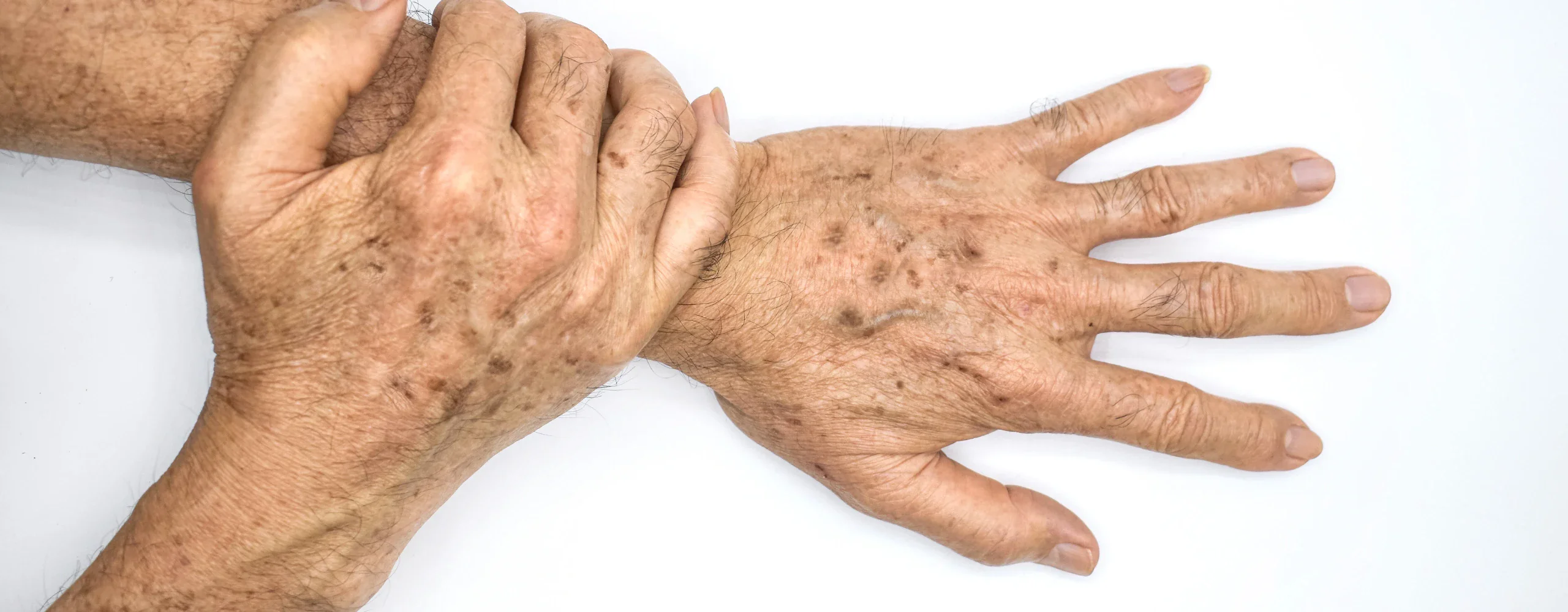 ผิวแห้ง คัน เป็นรอยดํา ปัญหาผิวอะไร พร้อมวิธีป้องกันและรักษารอยดำ