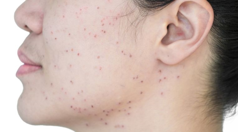 รักษากระด้วยเลเซอร์กระ กระแดด กระตื้น กระลึก ดีจริงไหม?