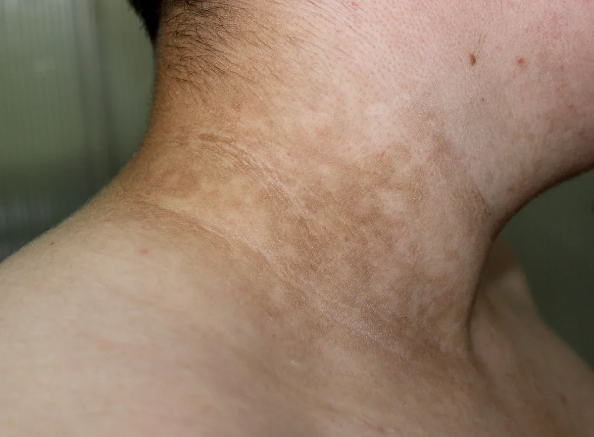 ผิวหนังช้าง (Acanthosis Nigricans) สัญญาณที่ต้องพบแพทย์