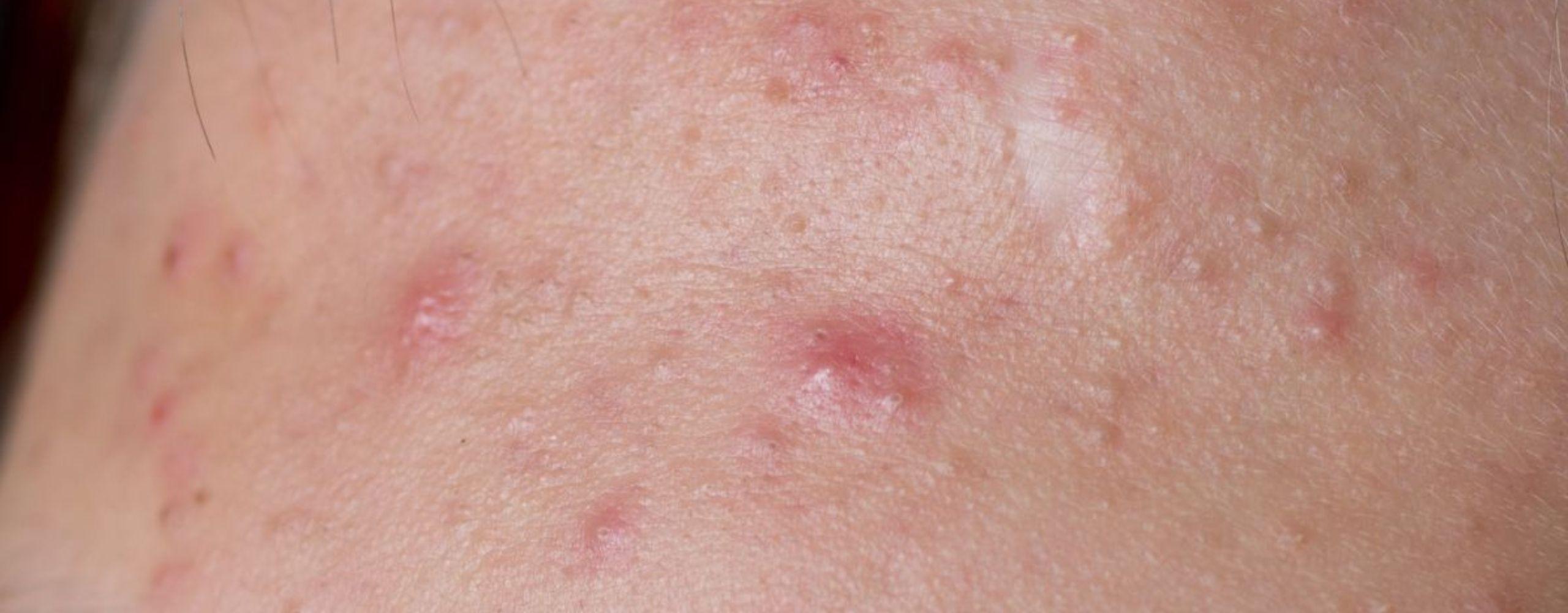 สาเหตุ วิธีรักษาสิวอักเสบ พร้อมเคล็ดลับดูแลผิวที่เป็นสิว