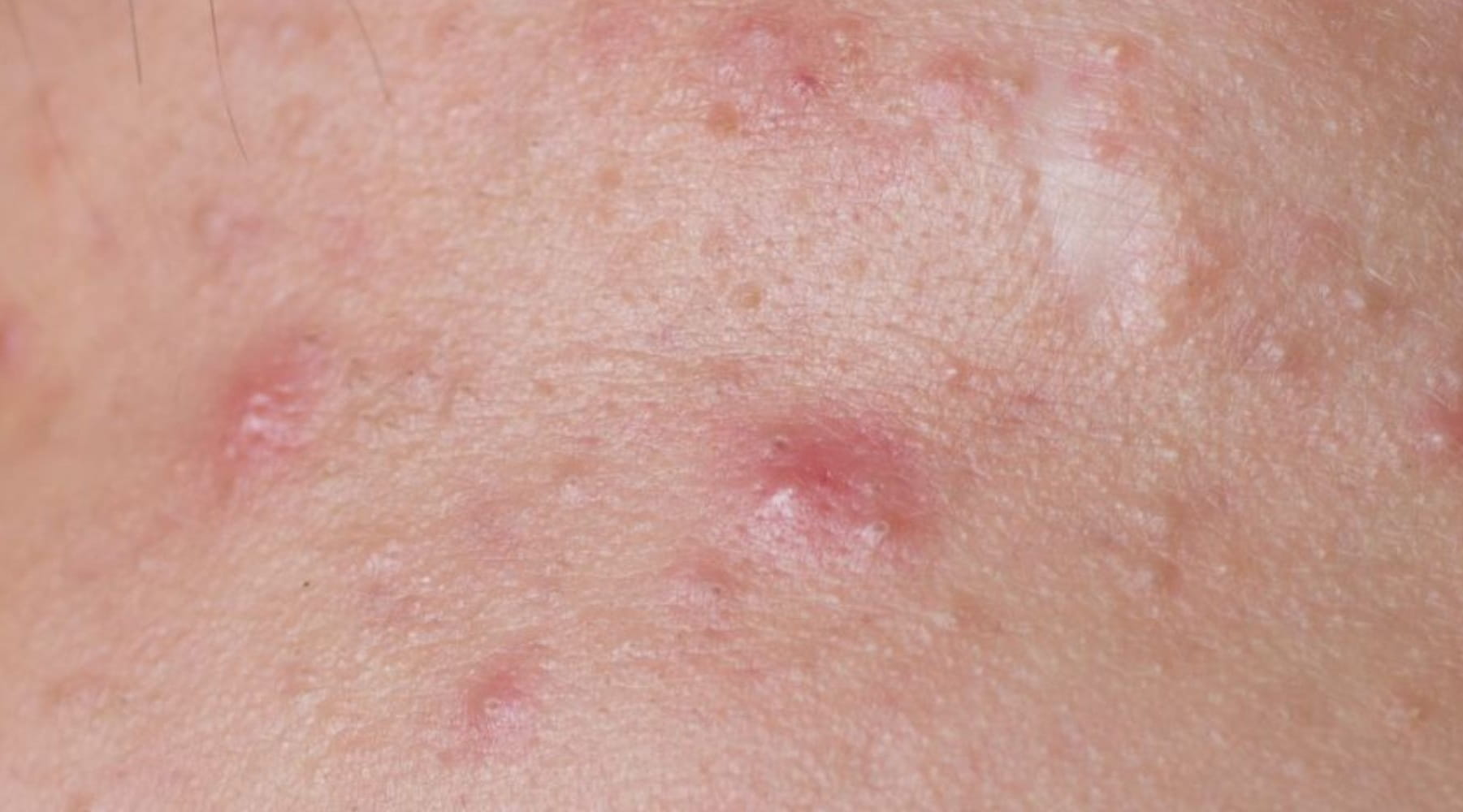 สาเหตุ วิธีรักษาสิวอักเสบ พร้อมเคล็ดลับดูแลผิวที่เป็นสิว