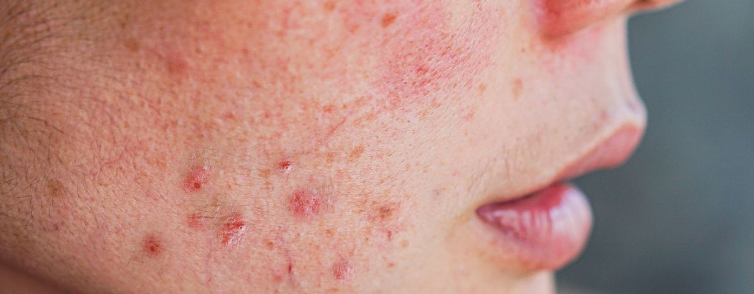 ป้องกัน สิวผด รับมือหน้าร้อนอย่างมั่นใจ พร้อมวิธีรักษาสิวผด