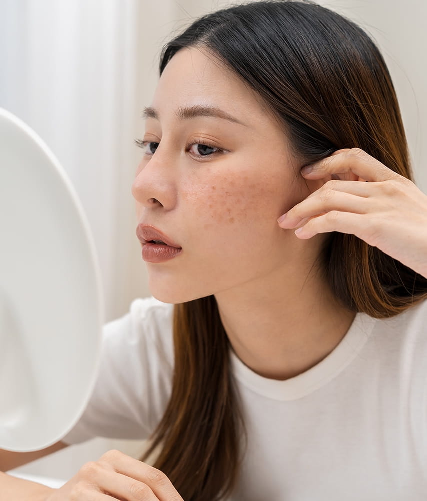 รวม 5 วิธีรักษาฝ้าด้วยวิธีธรรมชาติ เห็นผลจริงใน 7 วัน