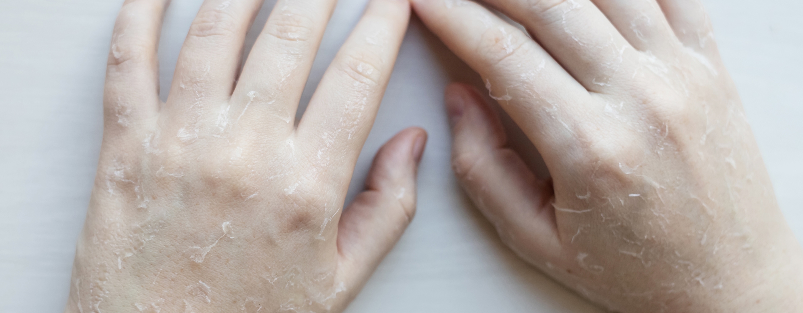 มือลอกเป็นขุย ไม่คัน เกิดจากอะไร ?  พร้อมวิธีรักษาอย่างเร่งด่วน