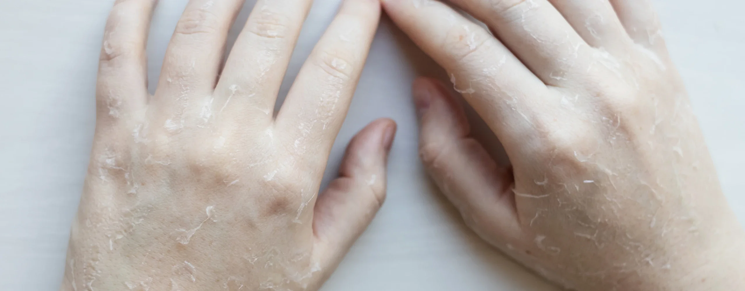 มือลอกเป็นขุย ไม่คัน เกิดจากอะไร ?  พร้อมวิธีรักษาอย่างเร่งด่วน