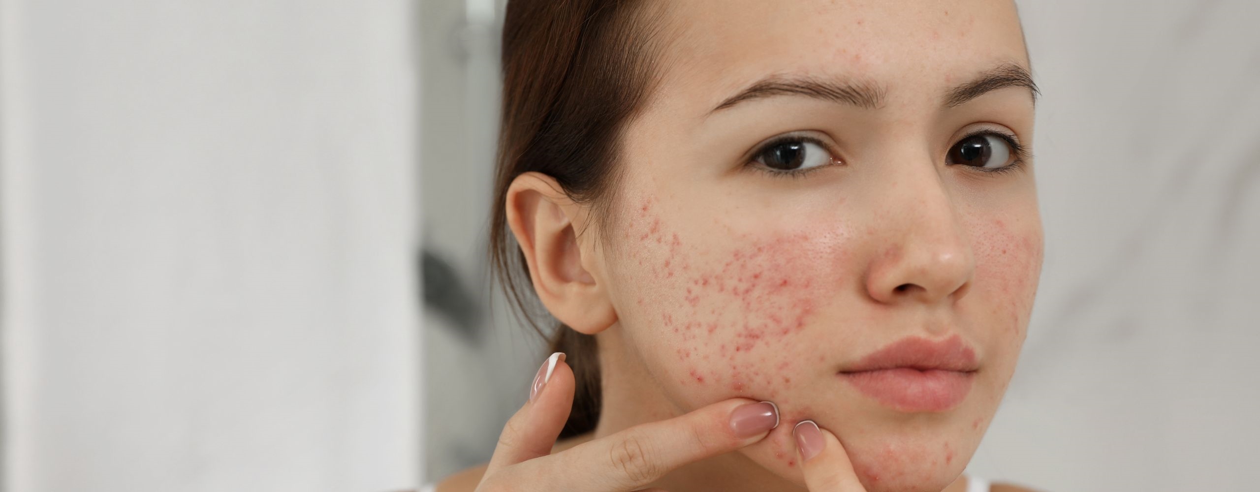 12 วิธีลดรอยแผลเป็นจากสิว ให้ผิวหน้ากลับมาเนียนใสก่อนสายเกินแก้