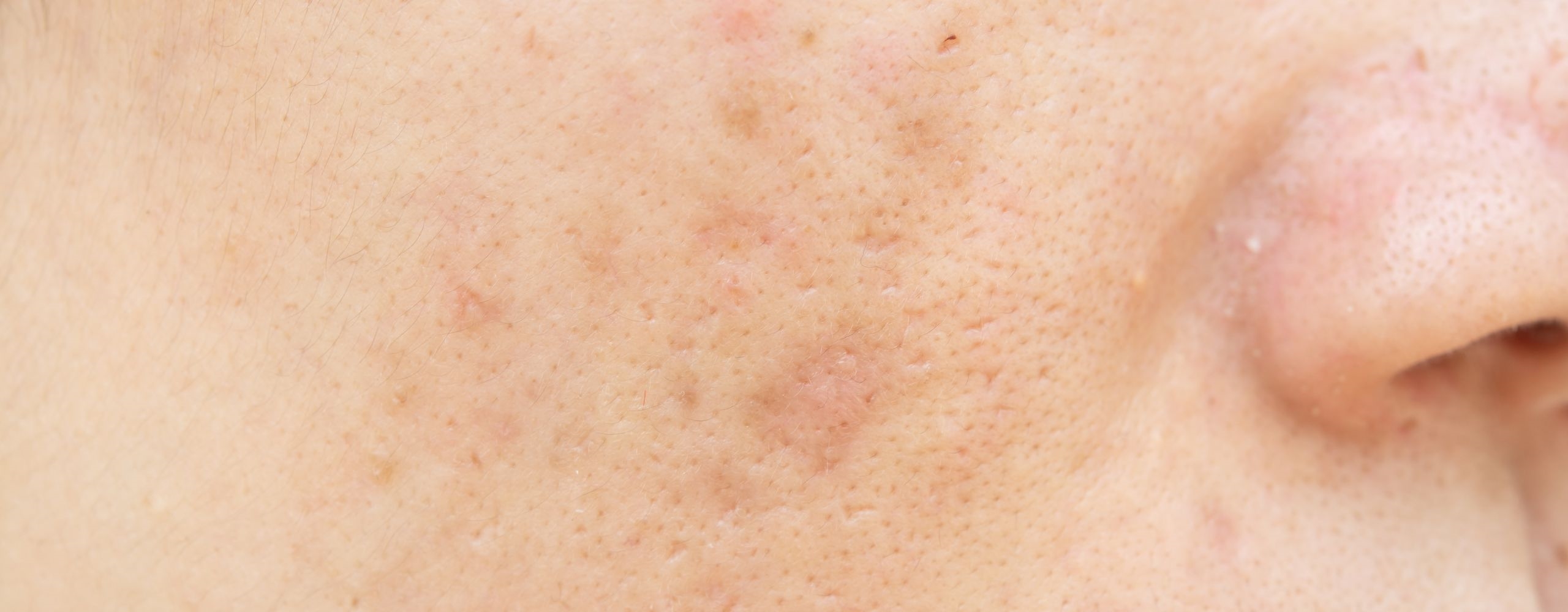 ทำไมรอยสิวไม่หาย? รวม 8 วิธีลดรอยดำจากสิวให้หายขาด