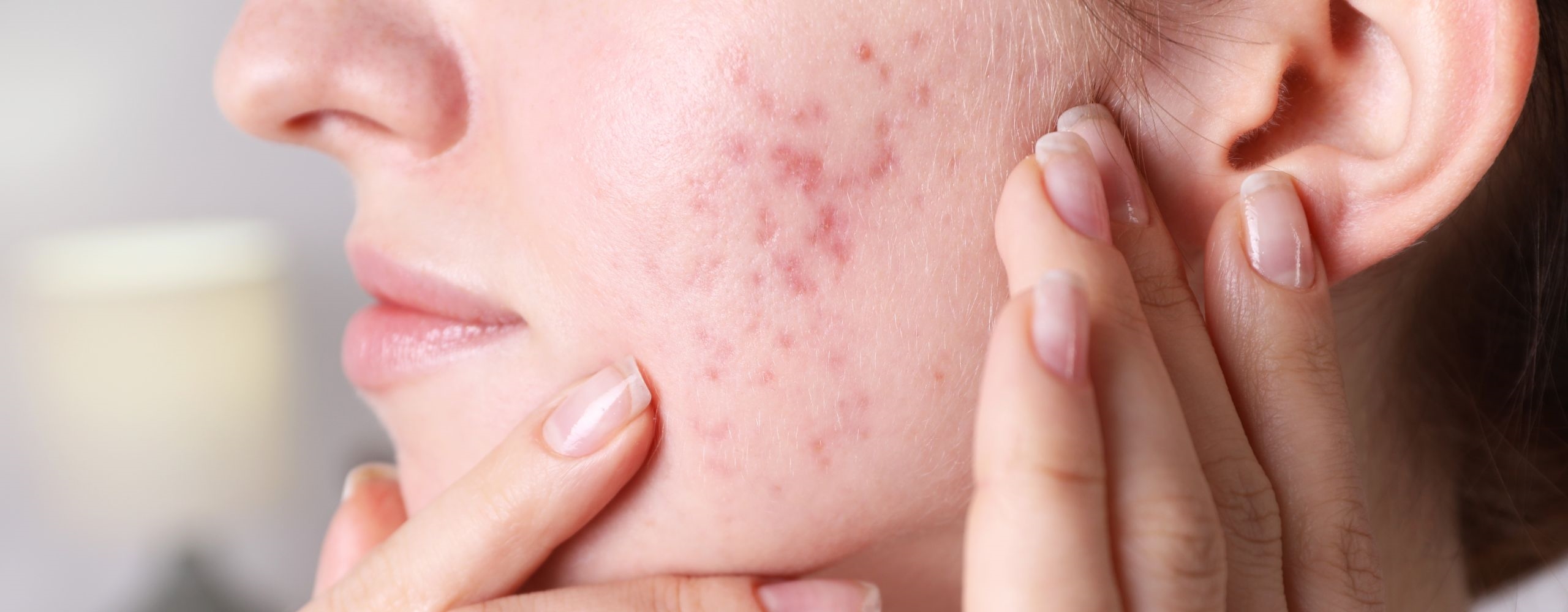 รู้จักสาเหตุและ 7 วิธีรักษารอยแดงจากสิวให้หายขาด