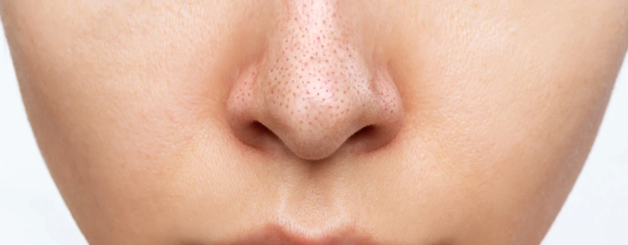 สิวเสี้ยน สาเหตุ อาการ คืออะไร รวม 3 วิธีจัดการให้ผิวเนียนใส