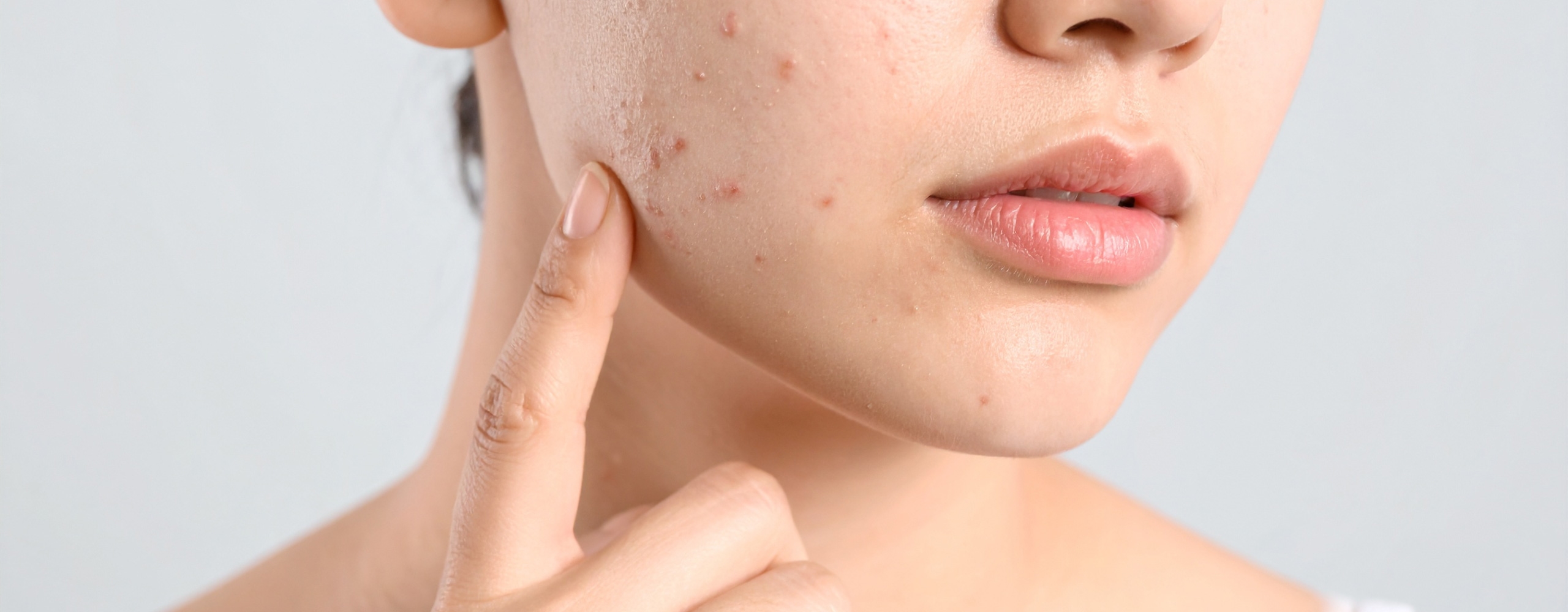 สิวฮอร์โมน คืออะไร? ทำไมชอบขึ้นที่คาง พร้อมวิธีตัดวงจรสิวซ้ำซากให้จบสิ้น