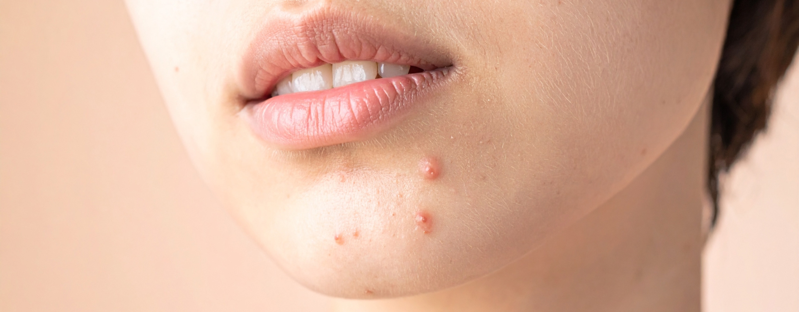 สิวไม่มีหัว คืออะไร? ทำไมกดแล้วรู้สึกเจ็บ รวมสาเหตุพร้อมวิธีรักษาให้ยุบไว ไม่ทิ้งรอย