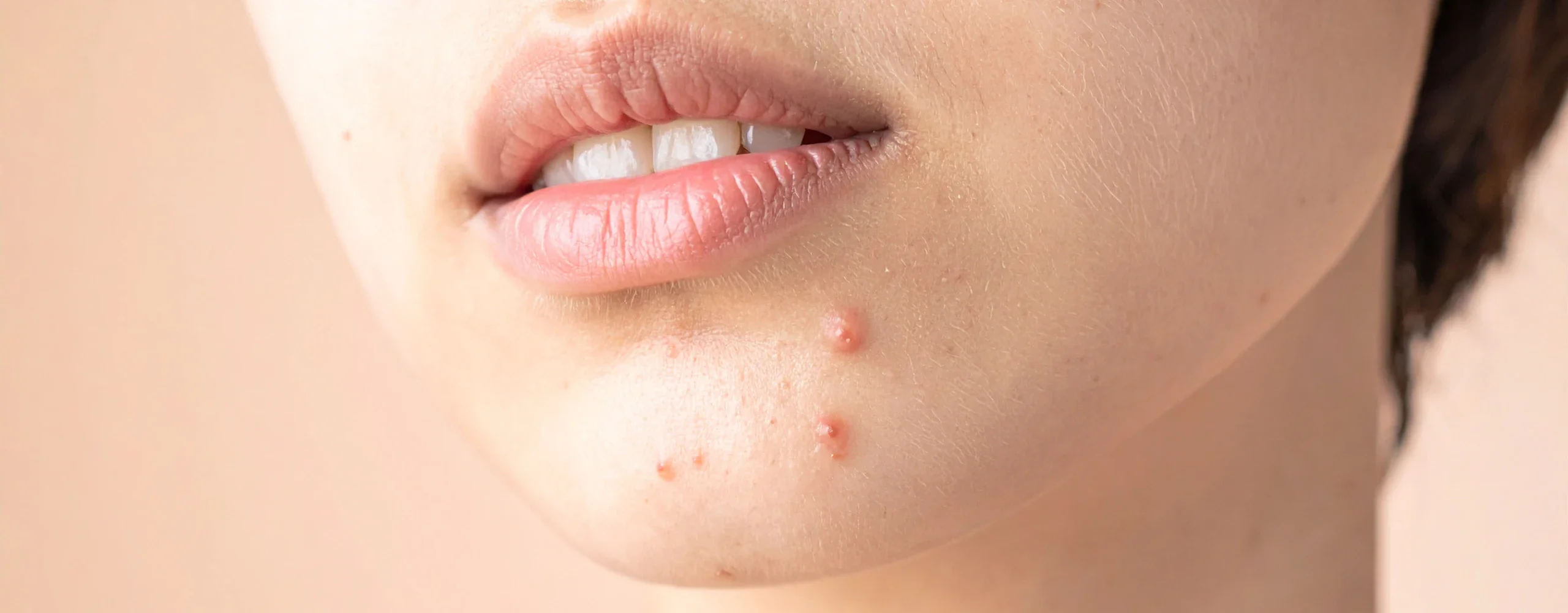 สิวไม่มีหัว คืออะไร? ทำไมกดแล้วรู้สึกเจ็บ รวมสาเหตุพร้อมวิธีรักษาให้ยุบไว ไม่ทิ้งรอย