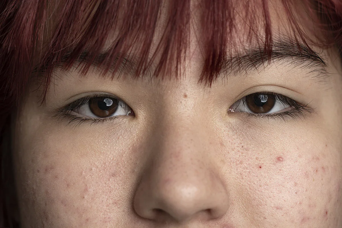 สิวไม่มีหัวมักขึ้นตรงไหนบ่อย