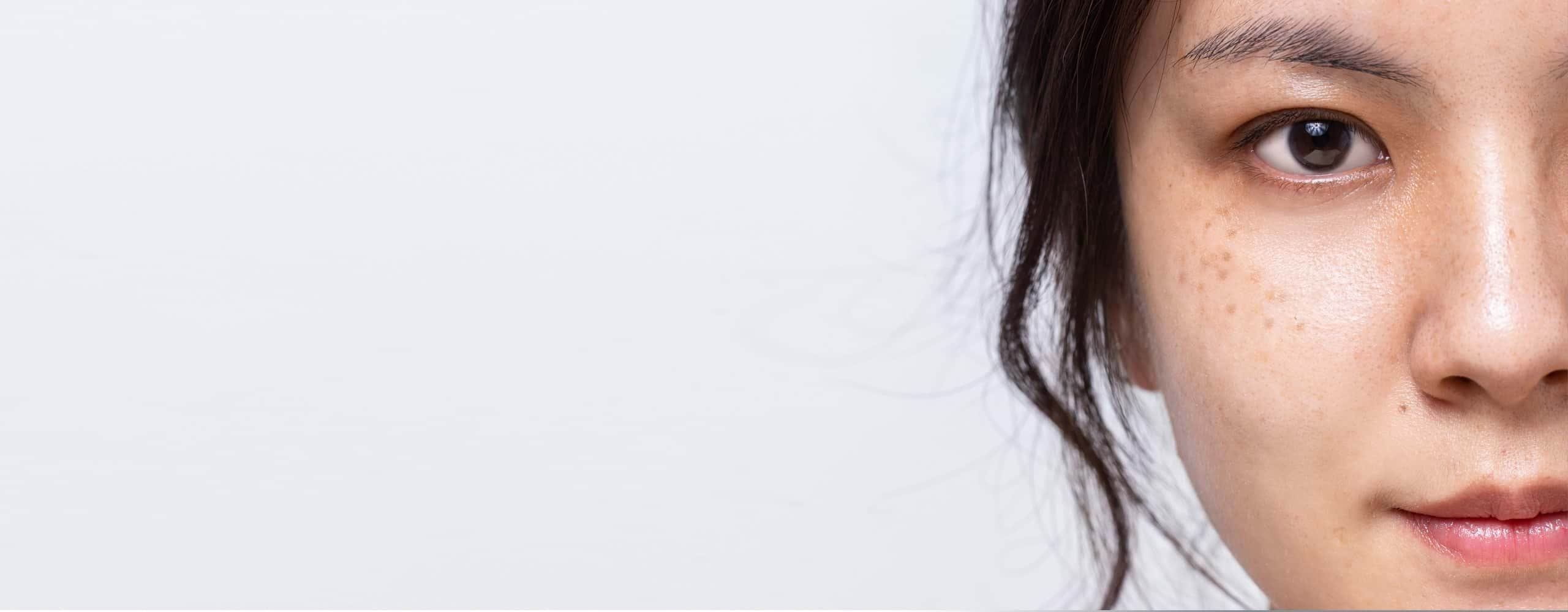 รู้จักชนิดของฝ้า สาเหตุและวิธีรักษาฝ้าอย่างถูกต้อง