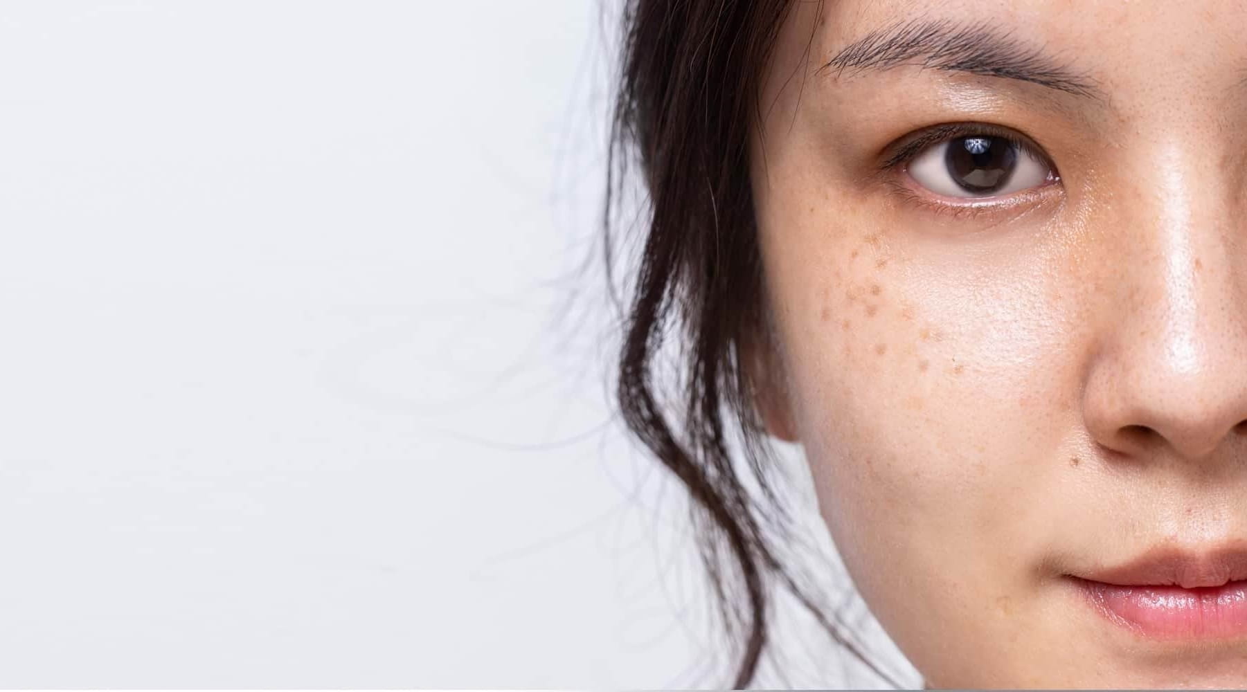 รู้จักชนิดของฝ้า สาเหตุและวิธีรักษาฝ้าอย่างถูกต้อง